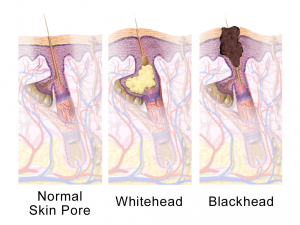 Acne types Pores